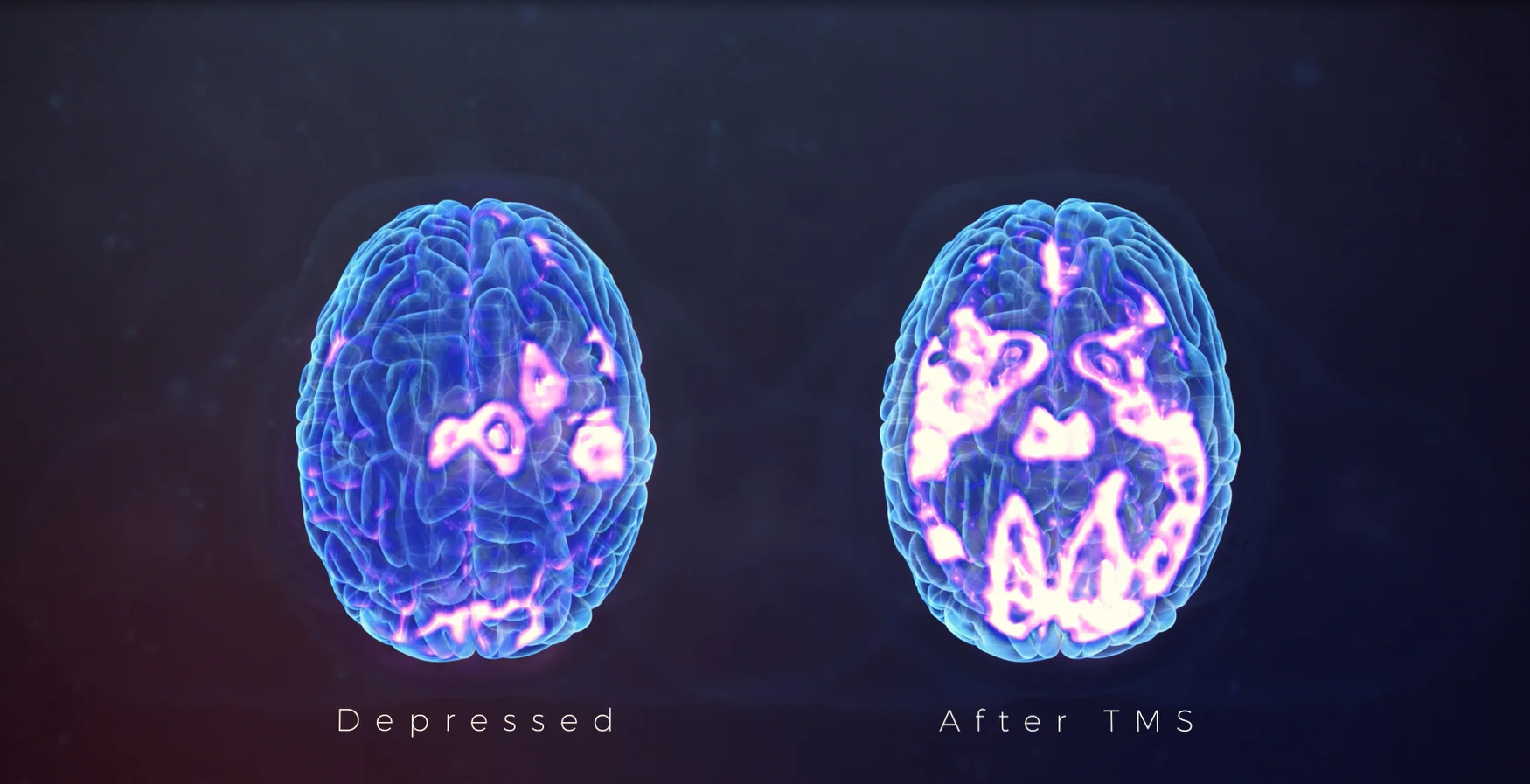 Brain Activity Levels Before and After TMS Treatments