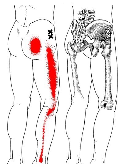 Upper Back, Shoulder, and Arm  The Trigger Point & Referred Pain