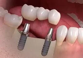 Dental Implants in Kendall: Your Complete Guide to Permanent Tooth Replacement