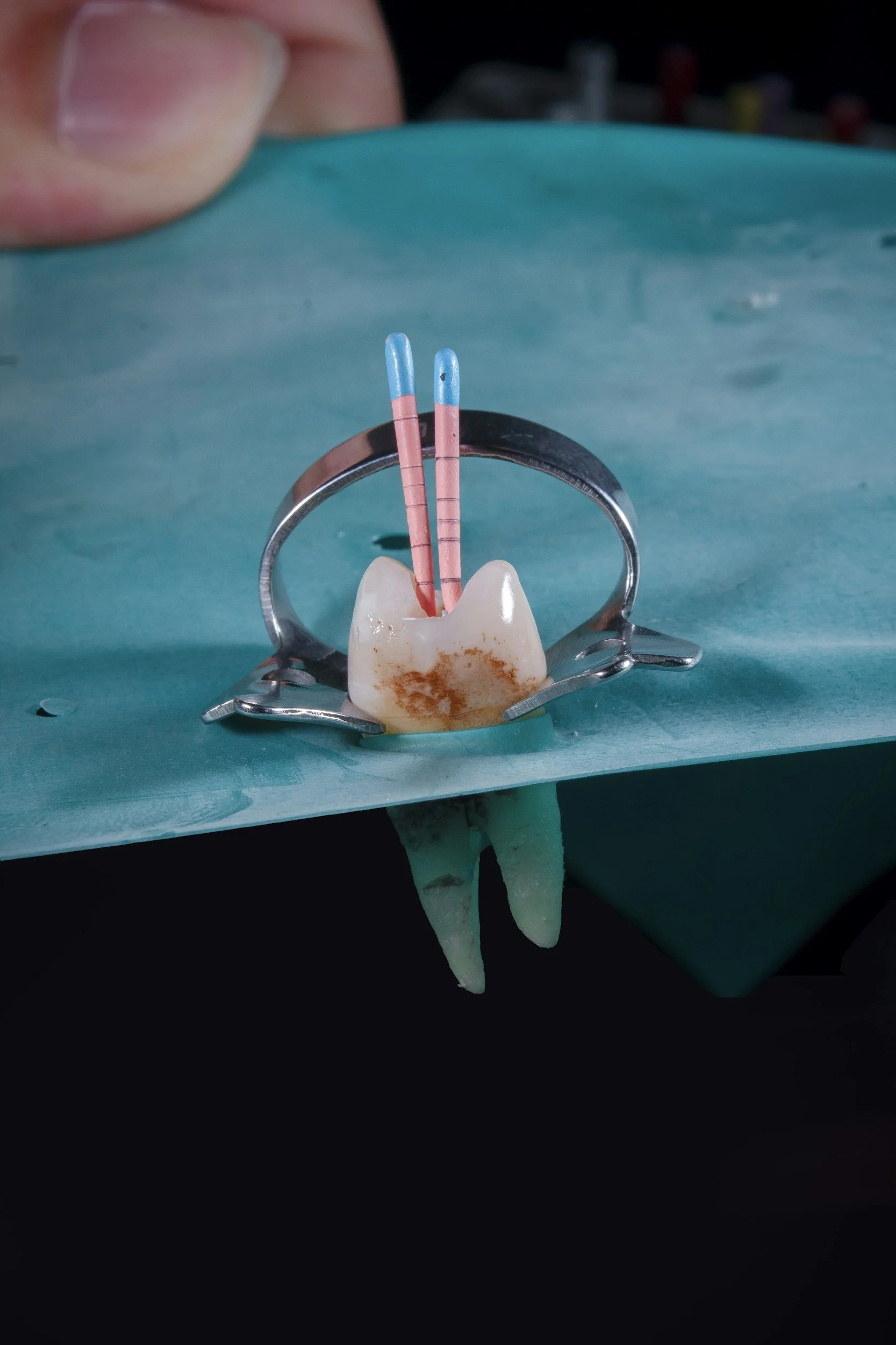 Root Canal Therapy: What to Expect at Creative Toothwork