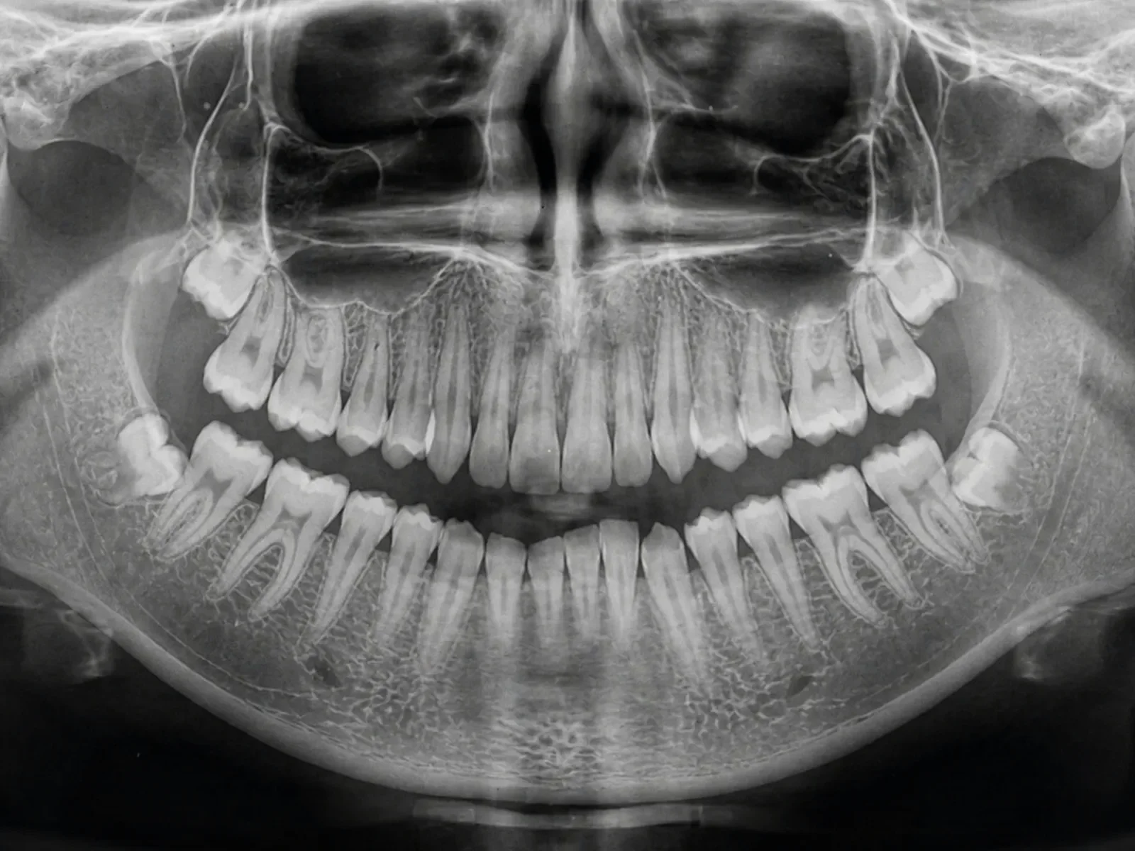 Wisdom Teeth Extraction: Everything You Need to Know