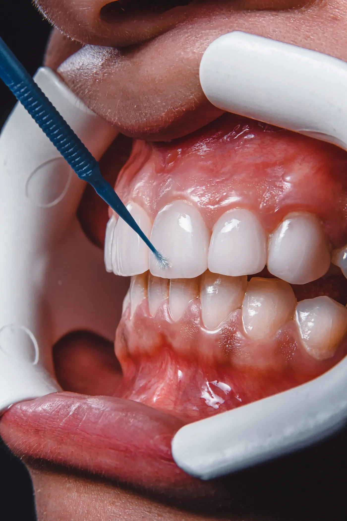 What is Minimally Invasive Dentistry?