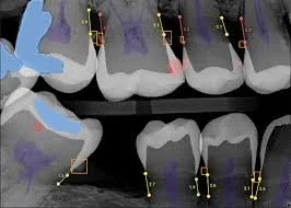 alt="Análisis de radiografía dental asistido por IA con Overjet mostrando caries y pérdida ósea"