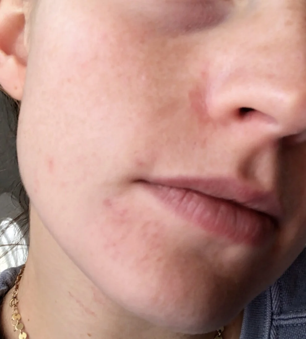 perioral dermatitis cure