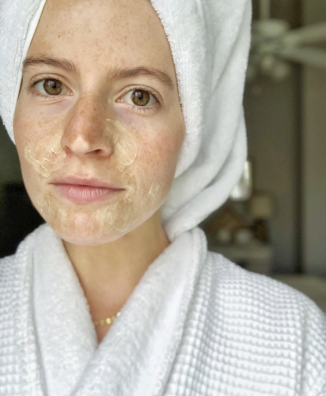 Perioral Dermatitis Healing &amp; Treatment Update 