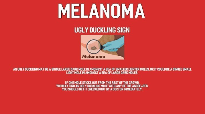 Let's check for Melanoma &bull; Ugly Duckling Sign

Ugly Duckling| Skin Cancer| Melanoma warning signs:
In the Ugly duckling method: a single large dark mole in amongst a sea of smaller lighter moles, 
or 
single small light mole in amongst a sea of 
