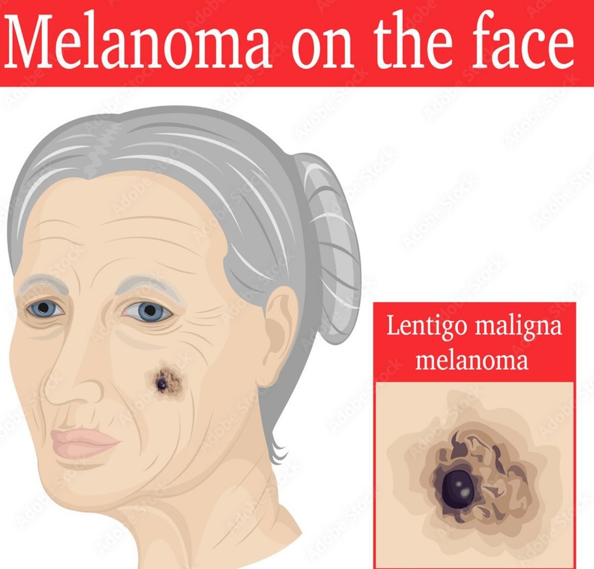 Lentigo Melanoma

There is a special kind of melanoma that develops on the face and very much associated with sun-exposure called lentigo maligna. It usually starts with a brown sunspot (lentigo), that with time becomes more irregularly colored, bord