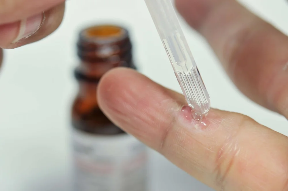 Remove warts with wart removal treatments.