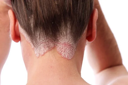 scalp psoriasis treatment and causes of scalp psoriasis.