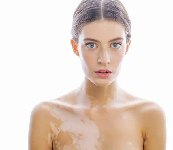 Symptoms of Vitiligo.