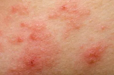 Cause of Eczema.