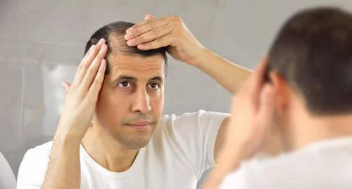 Living with Alopecia areata