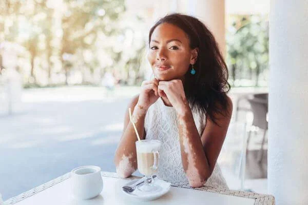 Vitiligo Frequently Asked Questions San Diego.
