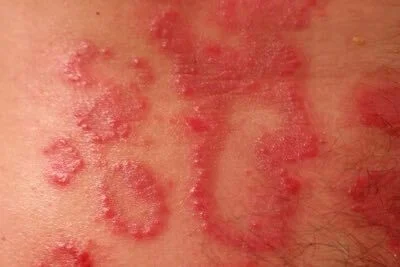 Other rashes that look like ringworm.