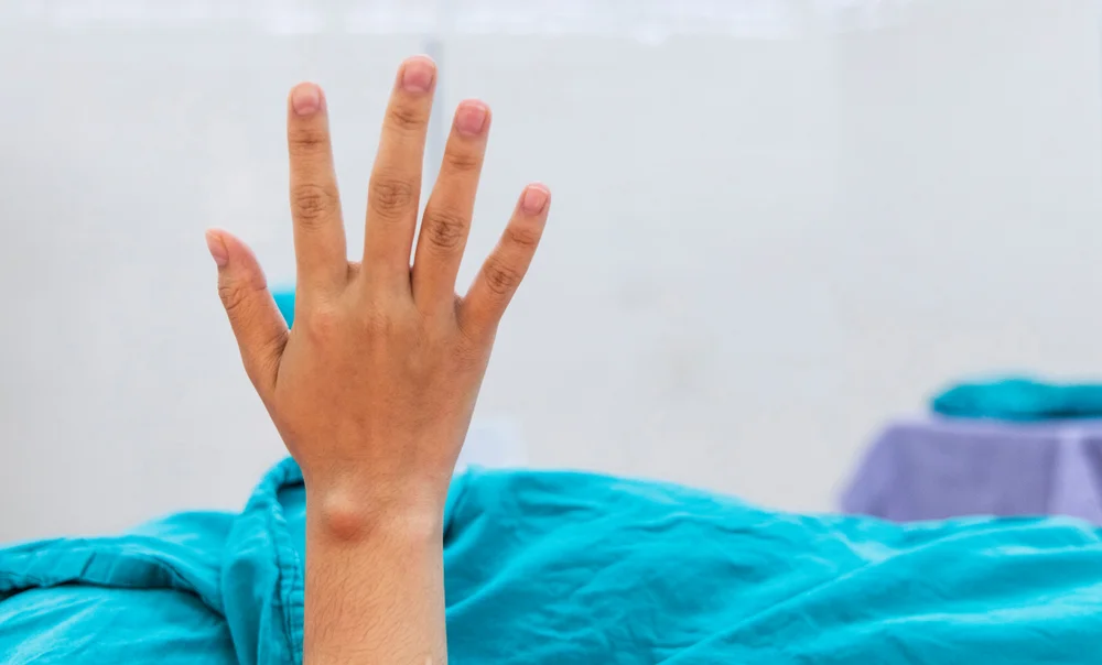 Myth Busted: Women Notice Freckle In Same Spot - Phenomenon or a Common Dermatology Finding?