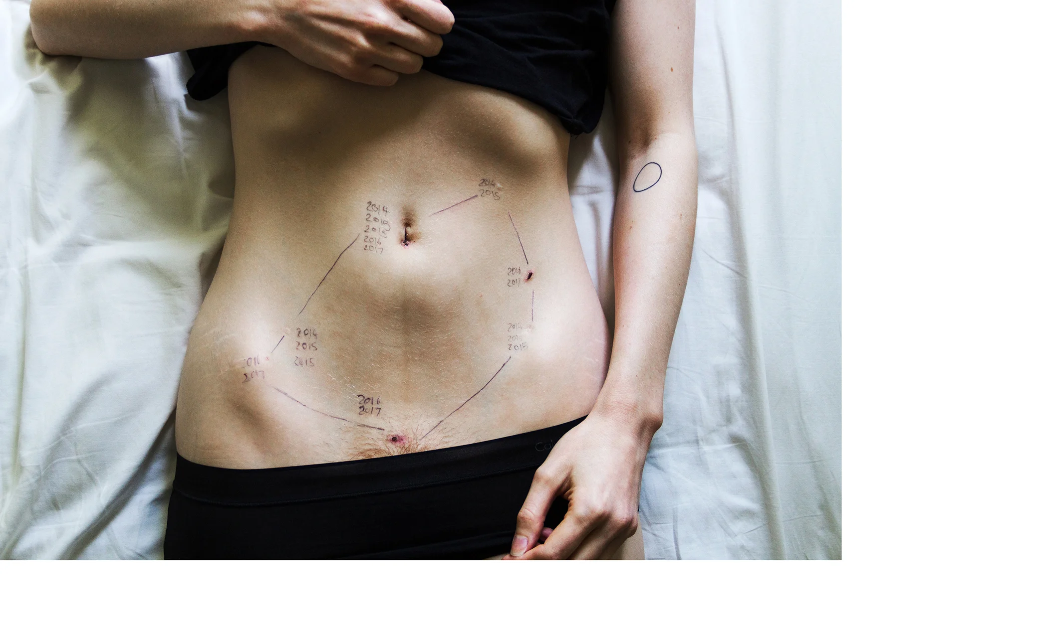 2014-2017, May 2017 from the series Endometriosis by Georgie Wileman https://www.georgiewileman.com/endo/
