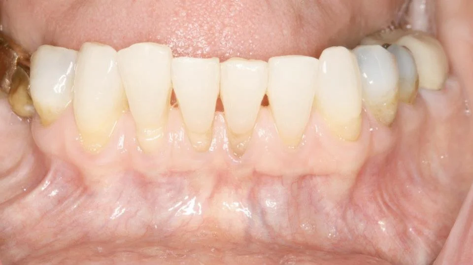 Before the Connective Tissue Graft We know how to evaluate the success rate of each individual gum recession case.
