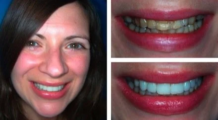 veneers1.jpg