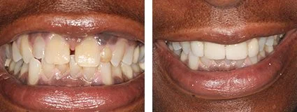 veneers2.jpg