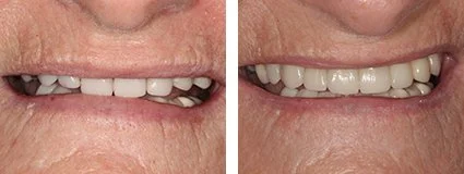 veneers3.jpg