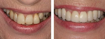 veneers4.jpg