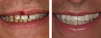 veneers5.jpg