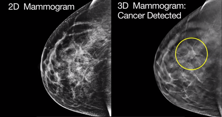 A small cancer that went undetected in a traditional 2D mammography scan (left) was detected in a 3D mammogram (right).