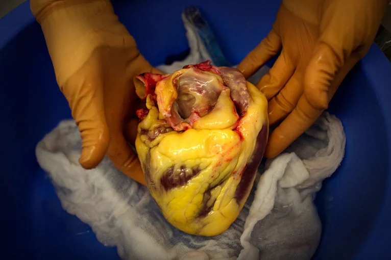This is the heart of an obese person. Remember, folks, this is happen when you get fat. Fat tissues builds up around the heart and clogs/chokes it. Fat is not beautiful, it is not to be glorified.