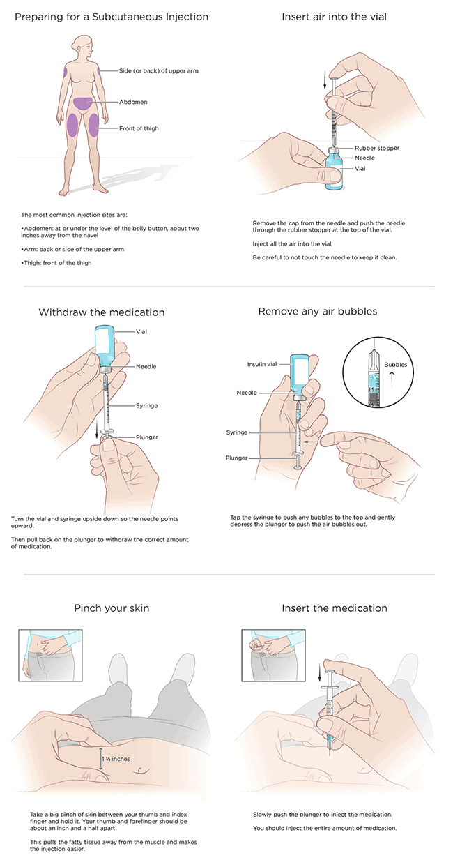What is a Subcutaneous Injection?