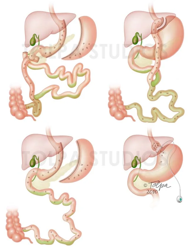 Obesity Surgical Options