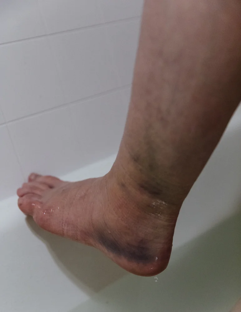 Freshly broken/swollen ankle. Took this while I was waiting for my surgery at the end of the week.