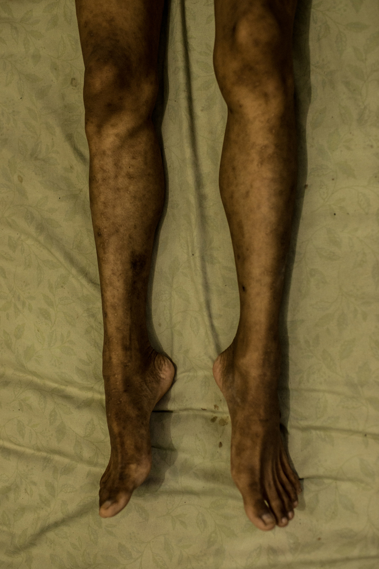  Ana's legs in full-blown AIDS. Ana is a young waria sex worker in Jakarta. Many waria are so poor that they often allow clients to have sex without using condoms to earn little more money. HIV is quickly spreading among this community and their clie