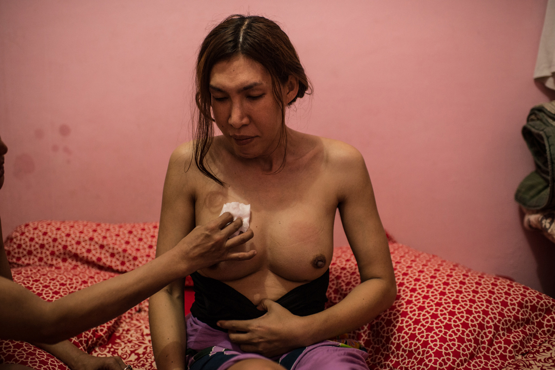  Susan, 27, after receiving collagen injections in her breast. Injecting collagen is the cheapest way for waria people to modify their body in order to align it with their soul: nose, cheeks, chin but also gluteus and breast are the most common parts