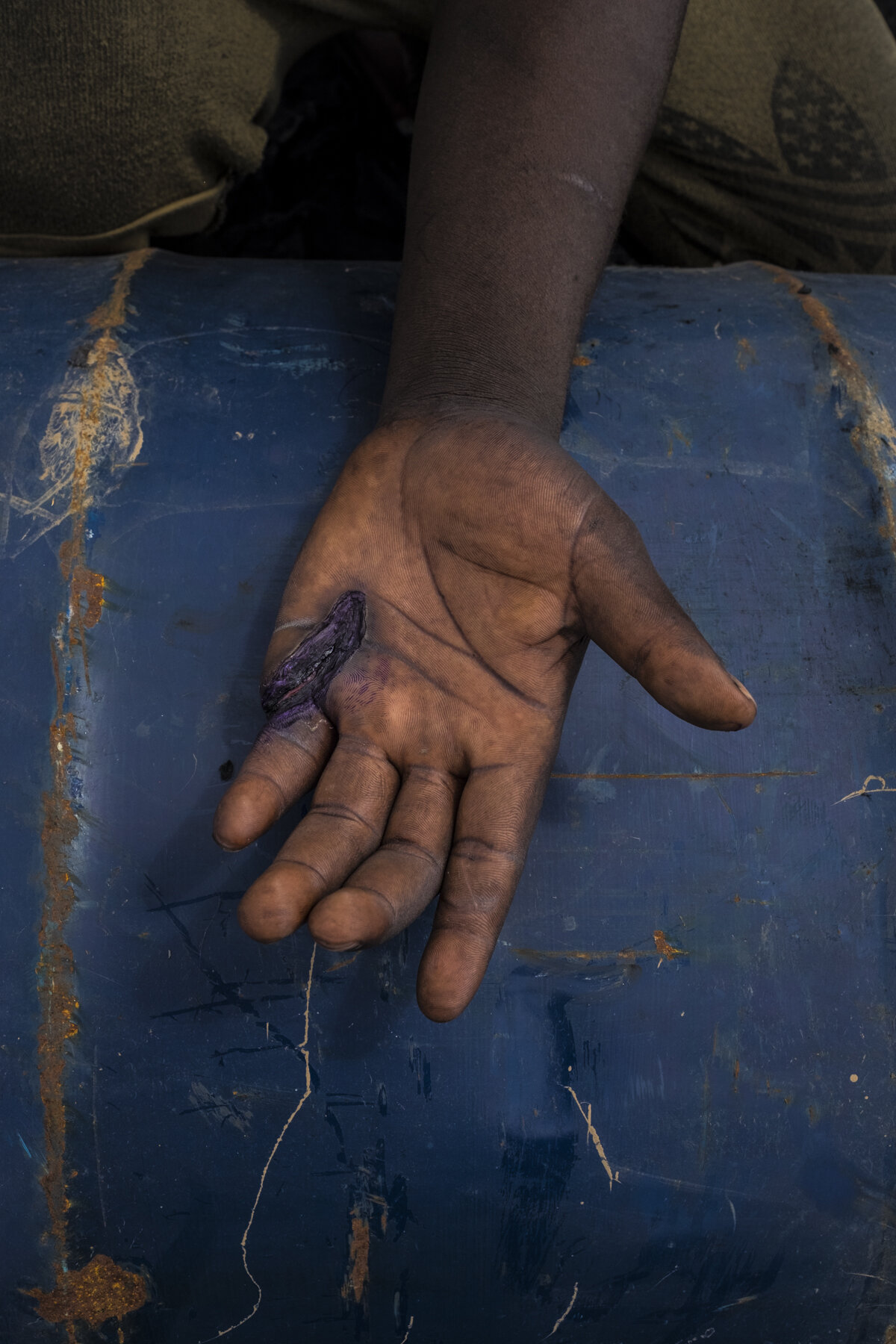  Ghana, Accra, October 2018. A worker's hand with a wound caused by the burning of cables, computers and other appliances in the Agbogbloshie scrap yard. In most cases workers don't visit any doctors or take any medications, as they can not afford to