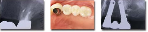 Failing bridge replaced by an implant supported bridge instead of a removable denture. One implant angled to use bone in front of maxillary sinus