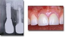 Upper central incisor replaced with an implant supported crown