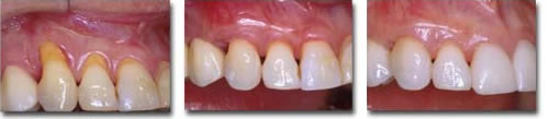 Gum Recession: before & after connective tissue root coverage/porcelain veneers are placed