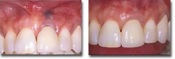 Before & after grafting with AlloDerm connective tissue implant & amalgam tattoo removal