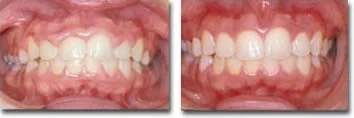 Before & after excess gum reshaping for enhanced esthetics & improved oral hygiene access