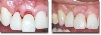 Healing after ridge preservation and before placement of a bridge