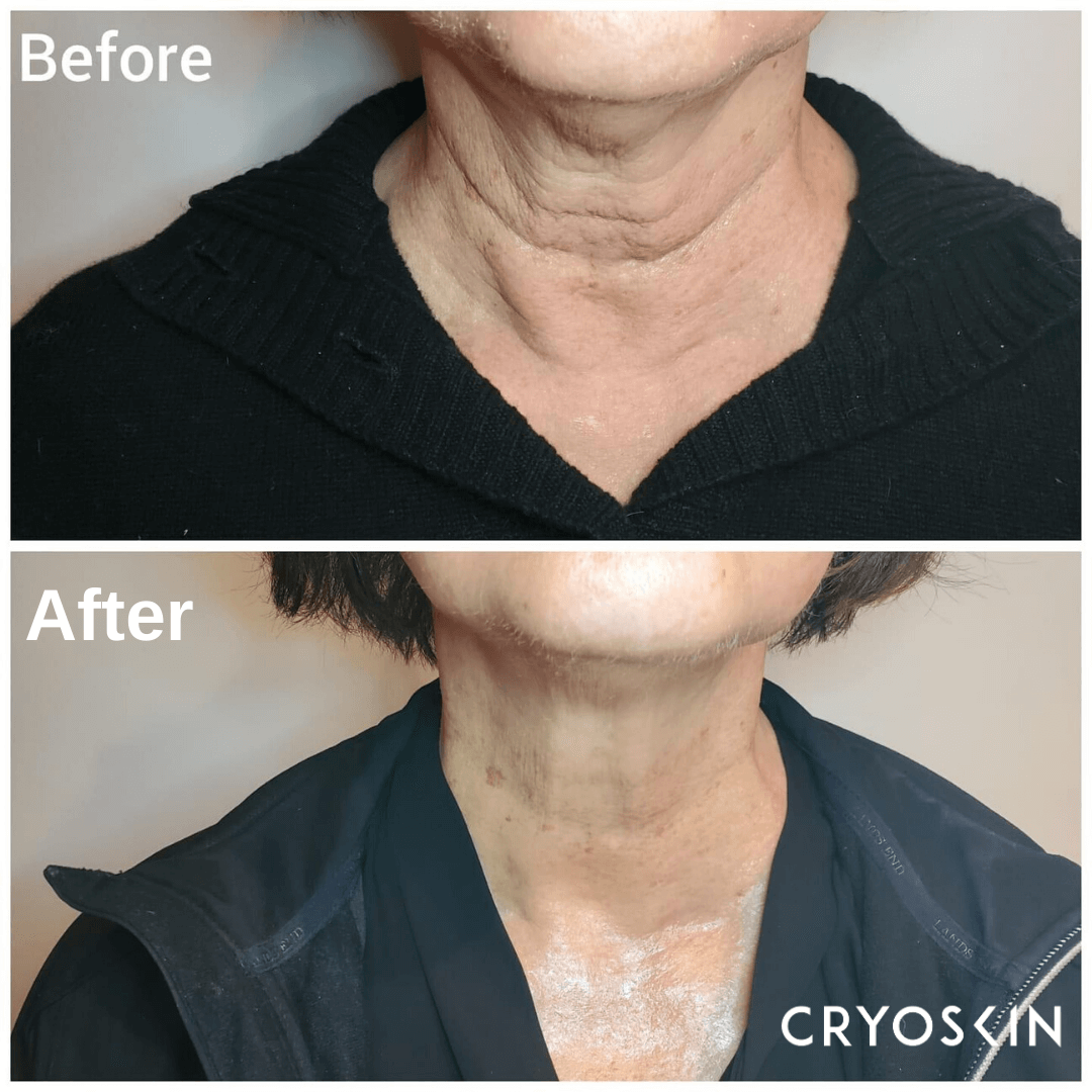 CryoFacial-neck-tightening-photo-credit-@aesthetics_by_sophia.png