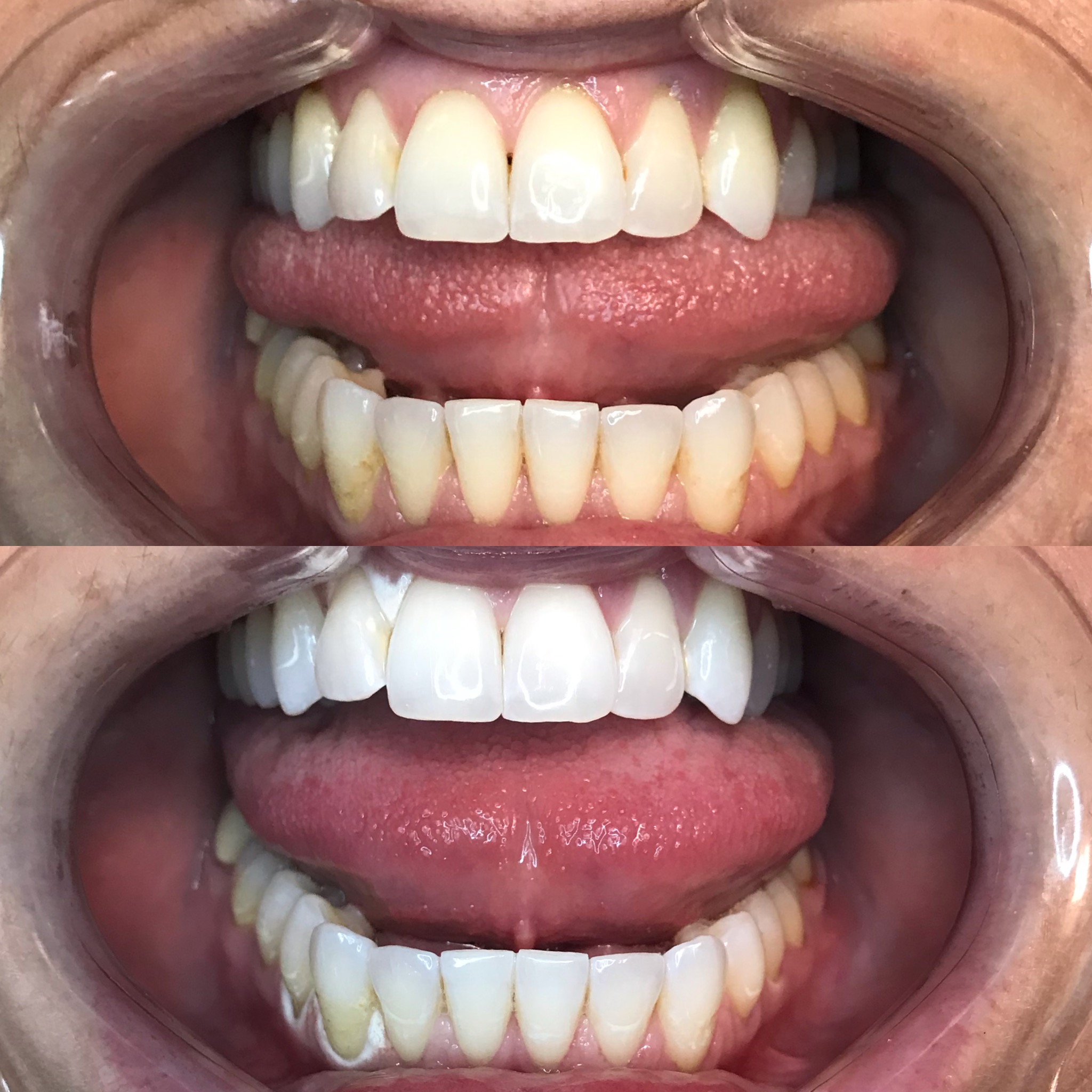 Before and after with no filter added! Whitening around the gums is temporary and goes away almost immediately!