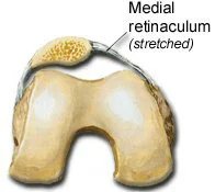 patella-stretched.jpg