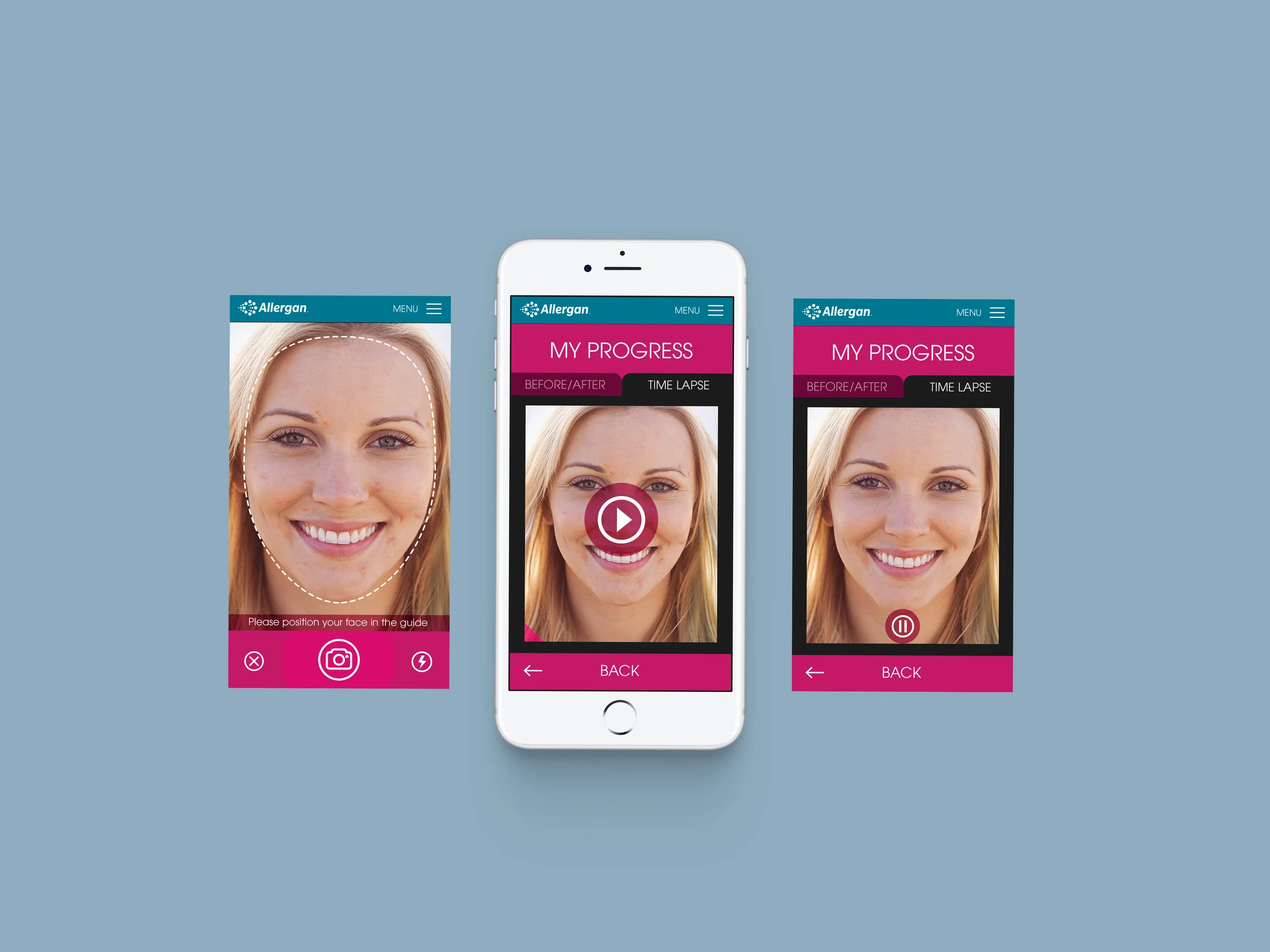 Allergan