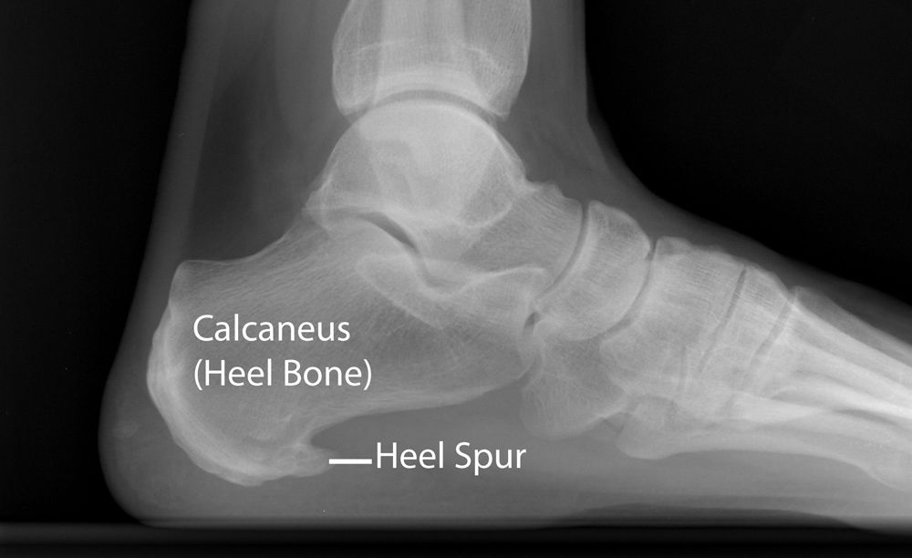 Heel spurs.jpg