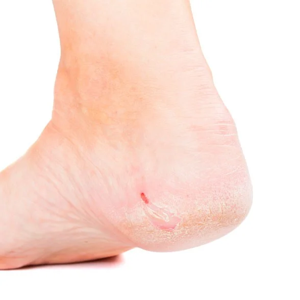 Diabetes Dry Cracked Feet