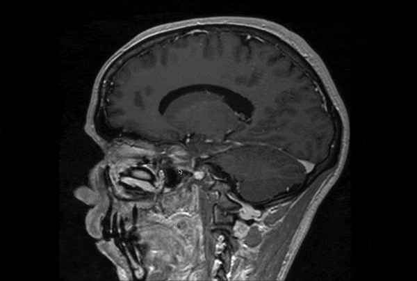 MRI scan / blowup