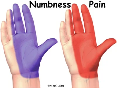 Figure 4 – Areas of numbness and pain.