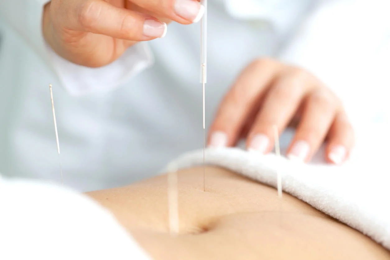 fertility acupuncture.jpg