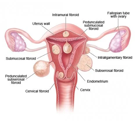 NIH-fibroids-illustration.jpg